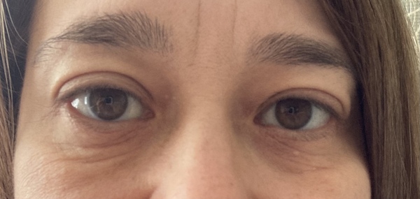 I look so old! What to do about my eyes?