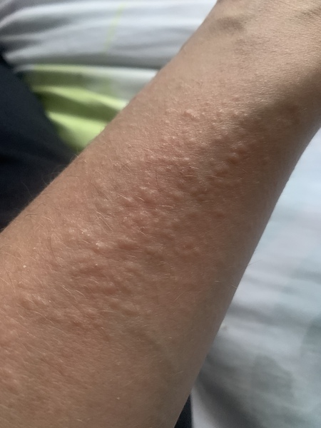 Lichen planus or dermatitis herpetiformis