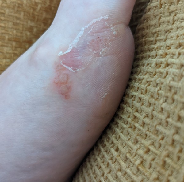 *Gross picture alert* - What's this on my foot??