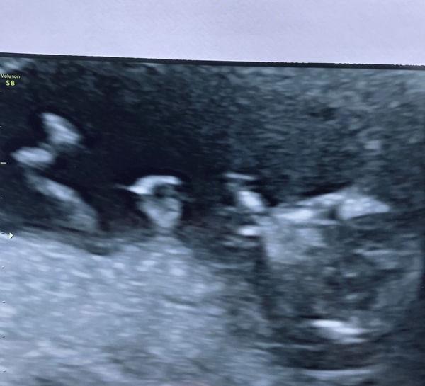 12 week scan, baby has flat face! Worried!