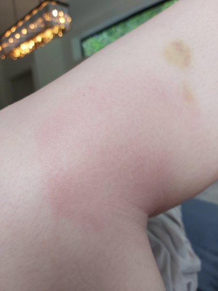 Is this a Lyme disease symptom?