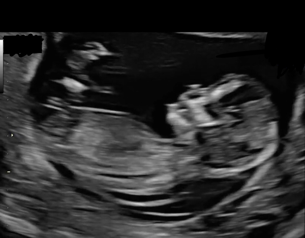 High NT, confusing screening results Down Syndrome