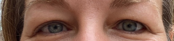 I look so old! What to do about my eyes?