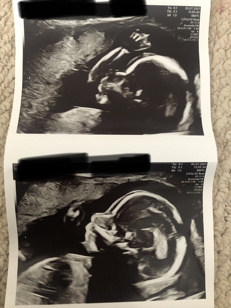 Girl or Boy - 20 Wks