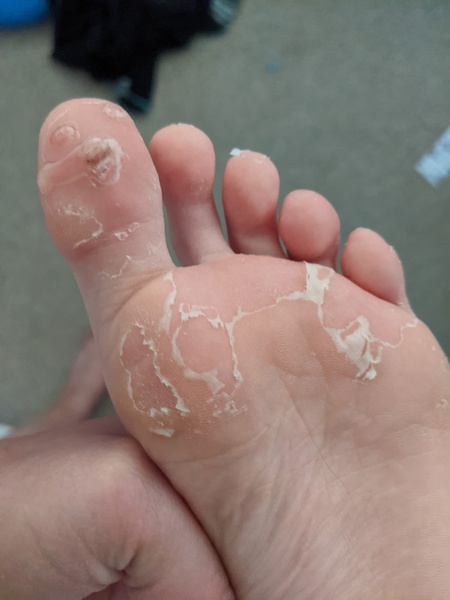 Roll up, roll up! Come and see DS' manky foot!