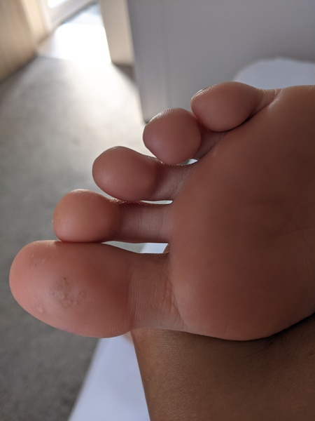 Roll up, roll up! Come and see DS' manky foot!