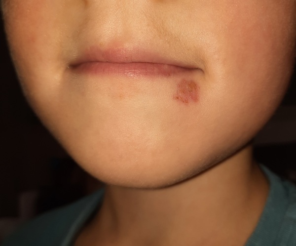 What's this in/ around 5yo mouth?