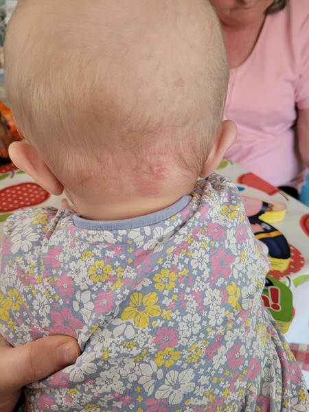 6 month old has a growing birth mark, do I get it checked out?