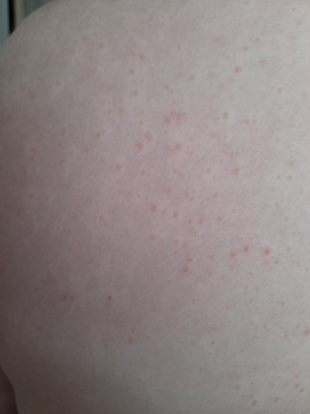 Rash