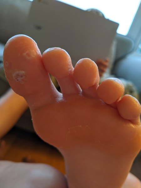 Roll up, roll up! Come and see DS' manky foot!