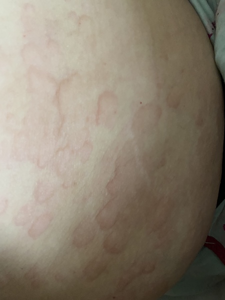 Random rash