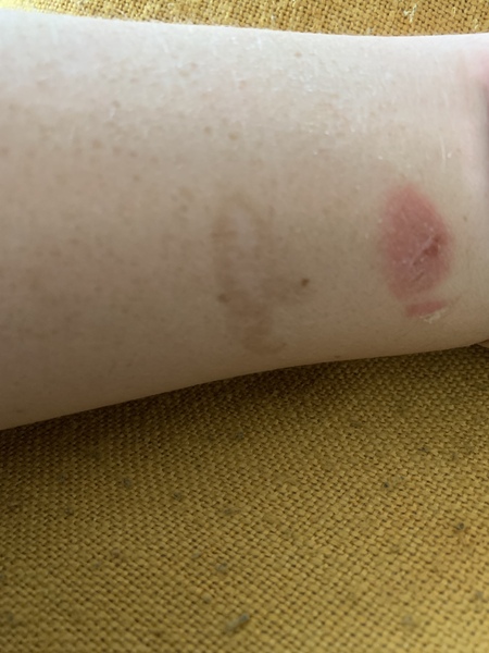 Anyone know about burns? Pic warning...