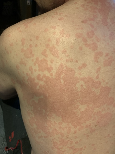 Rash