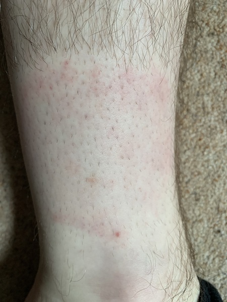 Is this a Lyme disease symptom?
