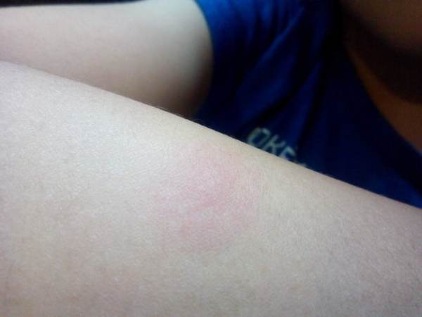 insect bites does anyone know