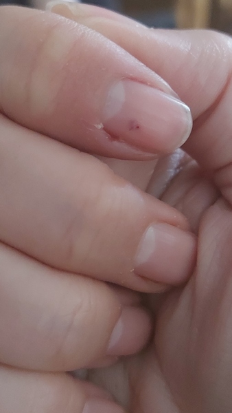 Feeling sorry for myself: tried to give the cat a worming tablet and she bit though my finger nail