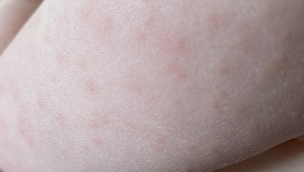 To think it isn't chickenpox after all?