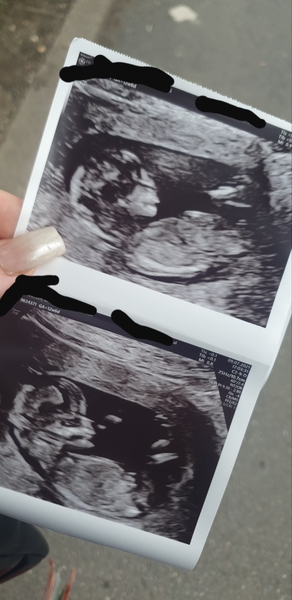 11+1 boy or girl what do we think?