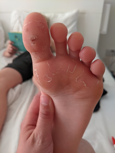 Roll up, roll up! Come and see DS' manky foot!