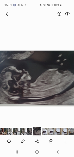 Any Sonographers here?