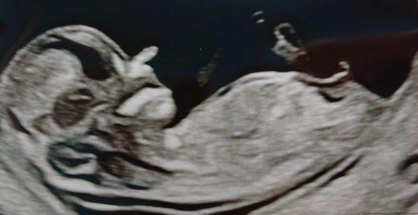Nub theory: reckon it's a boy or a girl?
