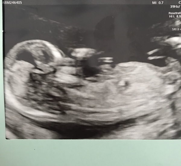 Can somebody have a go at guessing baby’s sex?