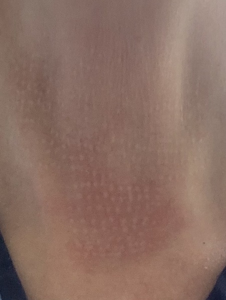 Has anyone been left with scarring after plasma pen/fibroblast?