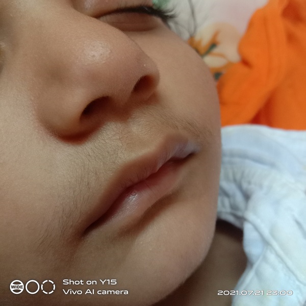 Anyone had slight facial hair on their toddlers ?