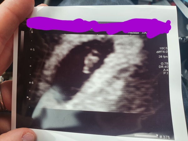 Pregnant after third miscarriage...