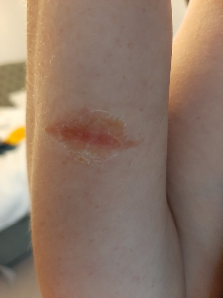 Anyone know about burns? Pic warning...