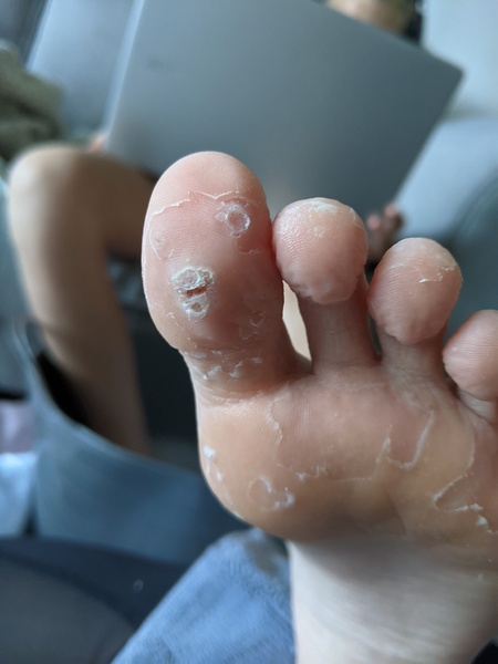 Roll up, roll up! Come and see DS' manky foot!