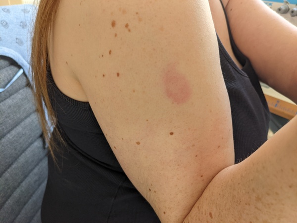 Side effects from vaccine, a week later!