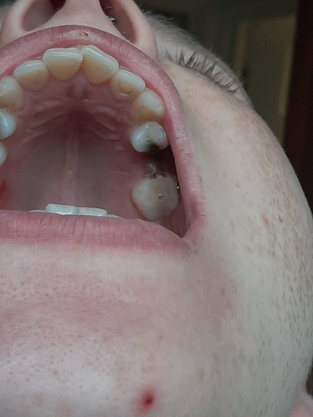 Help - is this dry socket?