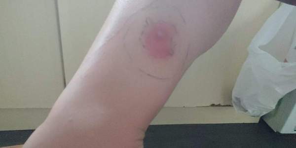 To pester the GP for this horse fly (I think) bite?