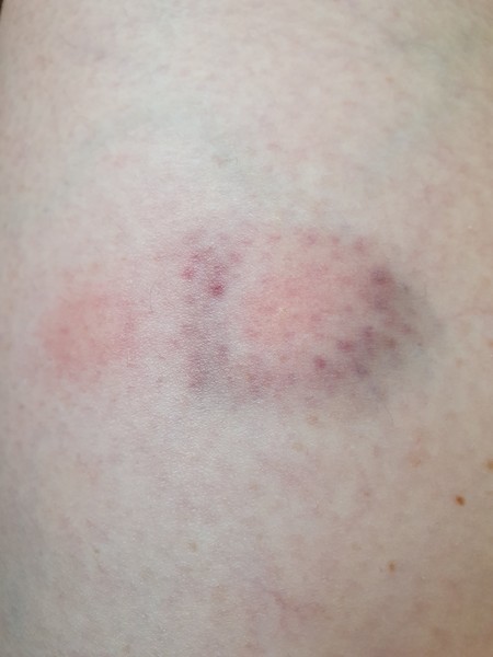 Are mosquitos in the U.K. a newish thing?