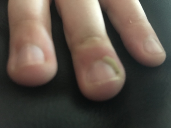 Finger bother