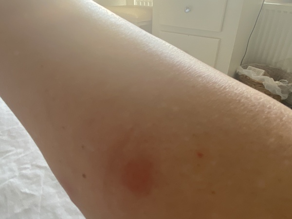 Are mosquitos in the U.K. a newish thing?