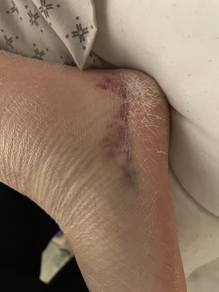 Diet & broken limbs/limited mobility (Terrified of weight gain)