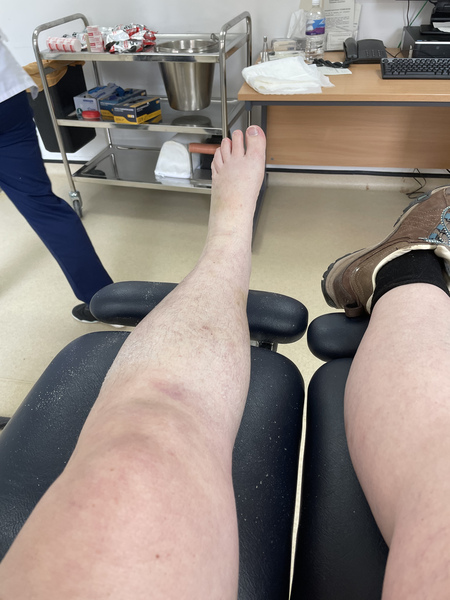 Diet & broken limbs/limited mobility (Terrified of weight gain)