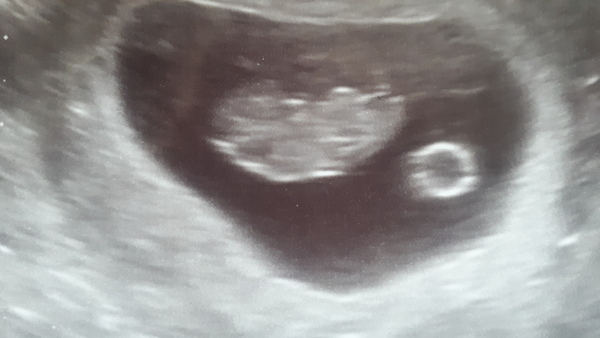 Concerned about dark spot on 9 week scan