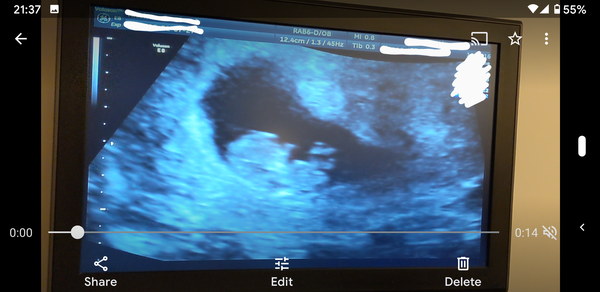 10 week scan