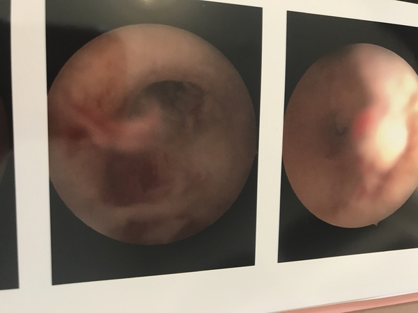 Why is conscious sedation not routinely offered for a hysteroscopy?