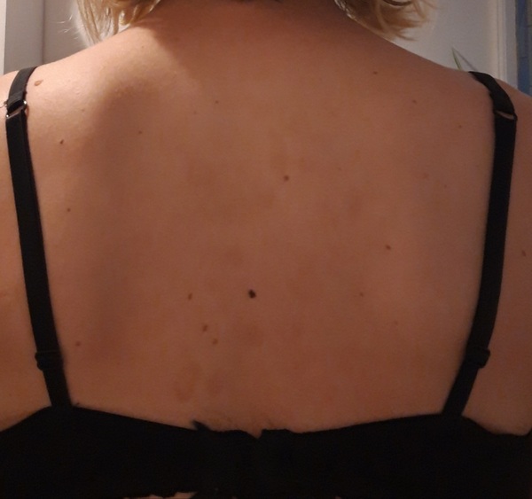 Weird rash