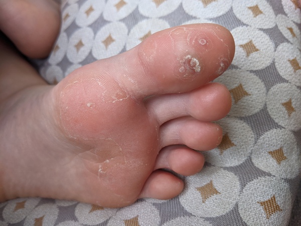 Roll up, roll up! Come and see DS' manky foot!