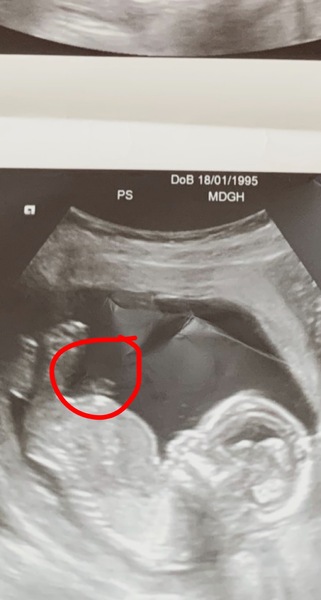 Scan picture 15 weeks, boy or girl?!?