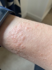 Lichen planus or dermatitis herpetiformis