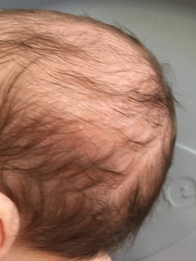 Baby acne or Cows Milk Allergy? Photos inc.