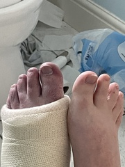 Diet & broken limbs/limited mobility (Terrified of weight gain)
