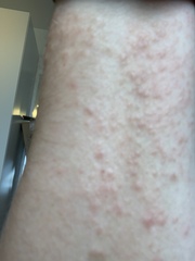 Lichen planus or dermatitis herpetiformis