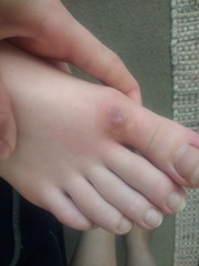 Insect bites (pictures) - anyone an expert on reactions to these?